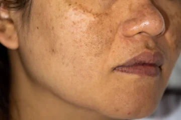 Melasma Relapse