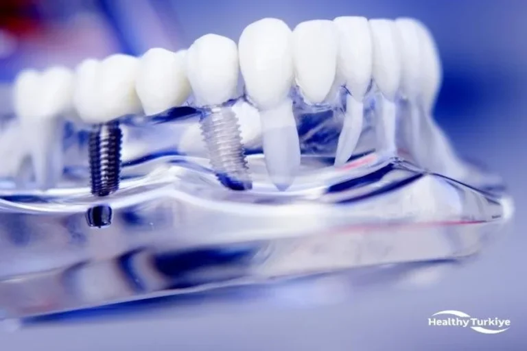 How All-on-4 Dental Implants in Turkey Offer a Similar Solution to All-on-6