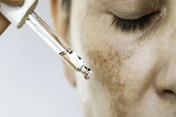 Is Melasma Treatment Safe for Sensitive Skin